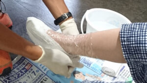 義肢装具士が、石膏を染み込ませた包帯を足に直接巻き、固めていきます