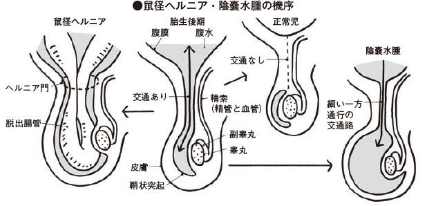 鼠径ヘルニア・陰嚢水腫の機序